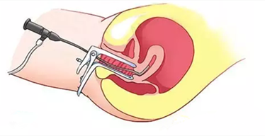 科普 | 一图看懂宫腔镜