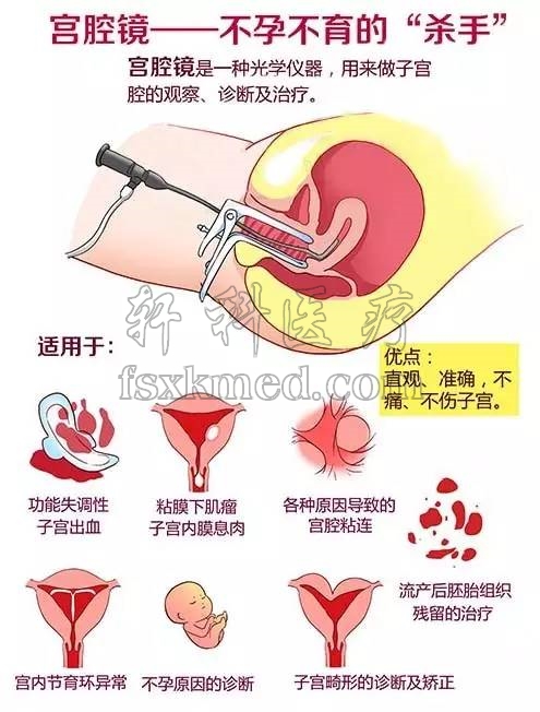 宫腔镜.jpg