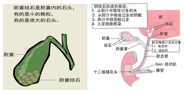 微创保胆取石---胆囊结石病人的福音