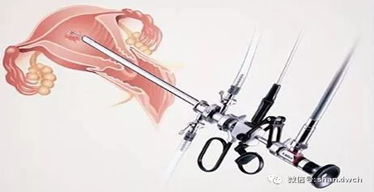 【妇科】带你了解什么是宫腔镜手术