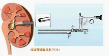 不懂经皮肾镜是什么？轩科告诉你！
