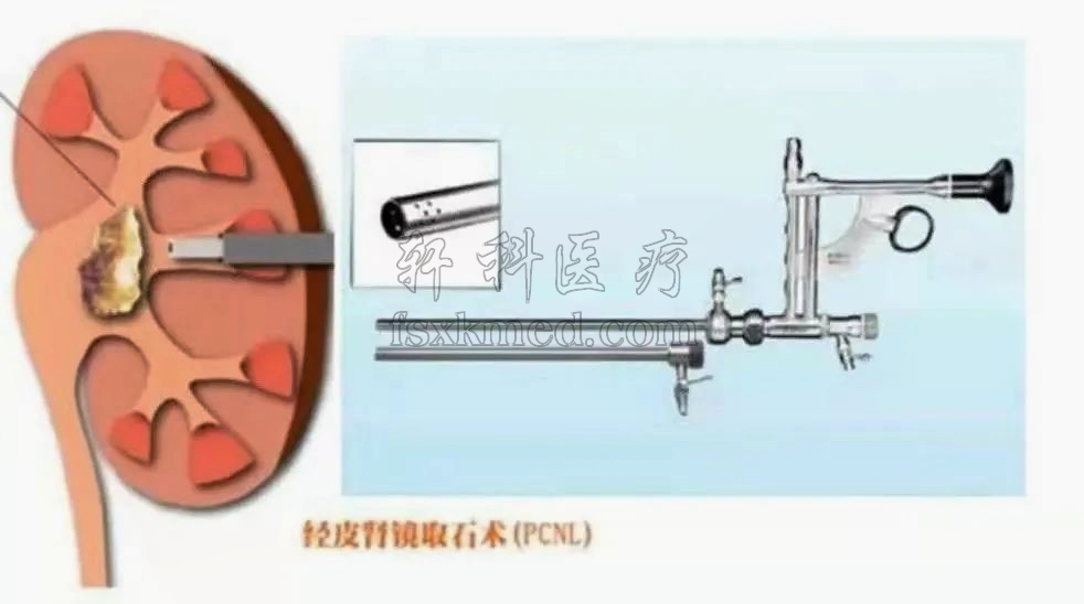图2-1  经皮肾镜.jpg